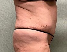 Tummy Tuck After Photo by Michael Yang, MD; Bettendorf, IA - Case 50986
