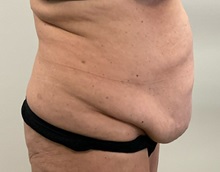 Tummy Tuck Before Photo by Michael Yang, MD; Bettendorf, IA - Case 50986