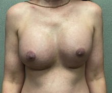 Breast Augmentation After Photo by Michael Yang, MD; Bettendorf, IA - Case 51029