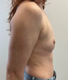 Breast Augmentation Before Photo by Michael Yang, MD; Bettendorf, IA - Case 51029