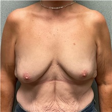 Breast Augmentation Before Photo by Michael Yang, MD; Bettendorf, IA - Case 51117