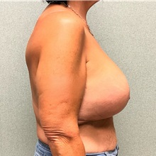 Breast Augmentation After Photo by Michael Yang, MD; Bettendorf, IA - Case 51117