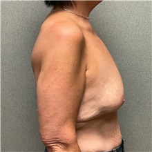 Breast Augmentation Before Photo by Michael Yang, MD; Bettendorf, IA - Case 51117