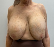 Breast Implant Removal Before Photo by Michael Yang, MD; Bettendorf, IA - Case 51466