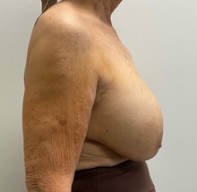 Breast Implant Removal Before Photo by Michael Yang, MD; Bettendorf, IA - Case 51466