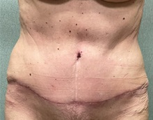 Tummy Tuck After Photo by Michael Yang, MD; Bettendorf, IA - Case 51469