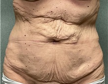 Tummy Tuck Before Photo by Michael Yang, MD; Bettendorf, IA - Case 51469