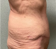 Tummy Tuck After Photo by Michael Yang, MD; Bettendorf, IA - Case 51469