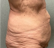 Tummy Tuck Before Photo by Michael Yang, MD; Bettendorf, IA - Case 51469