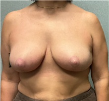 Breast Lift After Photo by Michael Yang, MD; Bettendorf, IA - Case 51468