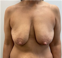 Breast Lift Before Photo by Michael Yang, MD; Bettendorf, IA - Case 51468