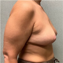 Breast Lift After Photo by Michael Yang, MD; Bettendorf, IA - Case 51468