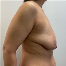 Breast Lift Before Photo by Michael Yang, MD; Bettendorf, IA - Case 51468