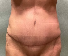 Tummy Tuck After Photo by Michael Yang, MD; Bettendorf, IA - Case 51470