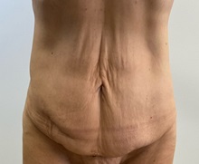 Tummy Tuck Before Photo by Michael Yang, MD; Bettendorf, IA - Case 51470