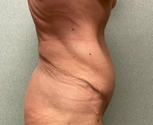 Tummy Tuck After Photo by Michael Yang, MD; Bettendorf, IA - Case 51470