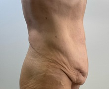 Tummy Tuck Before Photo by Michael Yang, MD; Bettendorf, IA - Case 51470