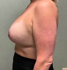 Breast Augmentation After Photo by Michael Yang, MD; Bettendorf, IA - Case 51472
