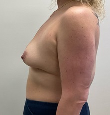Breast Augmentation Before Photo by Michael Yang, MD; Bettendorf, IA - Case 51472