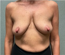 Breast Lift Before Photo by Michael Yang, MD; Bettendorf, IA - Case 51483