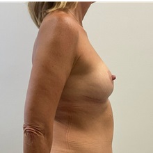 Breast Lift After Photo by Michael Yang, MD; Bettendorf, IA - Case 51483