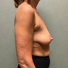 Breast Lift Before Photo by Michael Yang, MD; Bettendorf, IA - Case 51483