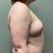 Breast Reduction After Photo by Michael Yang, MD; Bettendorf, IA - Case 51484