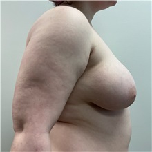 Breast Reduction Before Photo by Michael Yang, MD; Bettendorf, IA - Case 51484