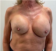 Breast Implant Revision Before Photo by Michael Yang, MD; Bettendorf, IA - Case 51485