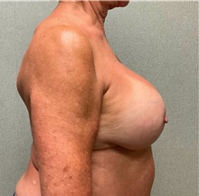Breast Implant Revision After Photo by Michael Yang, MD; Bettendorf, IA - Case 51485