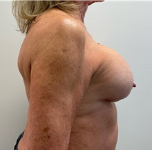 Breast Implant Revision Before Photo by Michael Yang, MD; Bettendorf, IA - Case 51485
