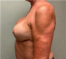 Breast Implant Revision After Photo by Michael Yang, MD; Bettendorf, IA - Case 51485