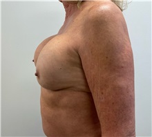 Breast Implant Revision Before Photo by Michael Yang, MD; Bettendorf, IA - Case 51485