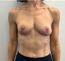 Breast Implant Removal After Photo by Michael Yang, MD; Bettendorf, IA - Case 51486