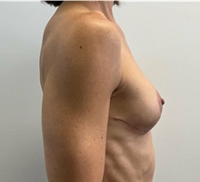 Breast Implant Removal After Photo by Michael Yang, MD; Bettendorf, IA - Case 51486