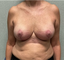 Breast Reduction After Photo by Michael Yang, MD; Bettendorf, IA - Case 51496