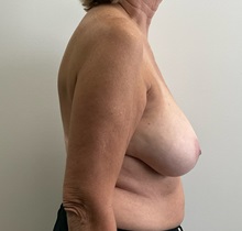 Breast Reduction Before Photo by Michael Yang, MD; Bettendorf, IA - Case 51496