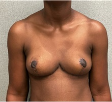 Breast Implant Removal After Photo by Michael Yang, MD; Bettendorf, IA - Case 51497