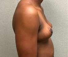 Breast Implant Removal After Photo by Michael Yang, MD; Bettendorf, IA - Case 51497