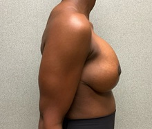 Breast Implant Removal Before Photo by Michael Yang, MD; Bettendorf, IA - Case 51497
