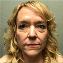Neck Lift Before Photo by Michael Yang, MD; Bettendorf, IA - Case 51528