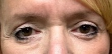 Eyelid Surgery After Photo by Michael Yang, MD; Bettendorf, IA - Case 51529