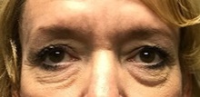 Eyelid Surgery Before Photo by Michael Yang, MD; Bettendorf, IA - Case 51529