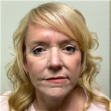 Facelift After Photo by Michael Yang, MD; Bettendorf, IA - Case 51538