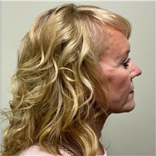 Facelift After Photo by Michael Yang, MD; Bettendorf, IA - Case 51538