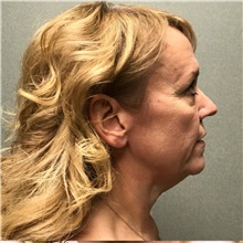 Facelift Before Photo by Michael Yang, MD; Bettendorf, IA - Case 51538