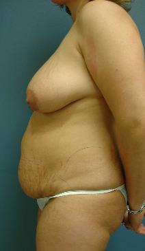Tummy Tuck Before Photo by James Lowe, MD; Oklahoma City, OK - Case 6754