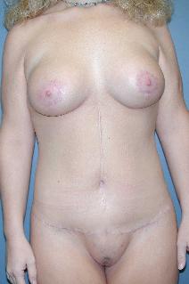 Body Contouring After Photo by James Lowe, MD; Oklahoma City, OK - Case 6756