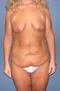 Body Contouring Before Photo by James Lowe, MD; Oklahoma City, OK - Case 6756