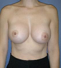 Breast Augmentation After Photo by James Lowe, MD; Oklahoma City, OK - Case 6760